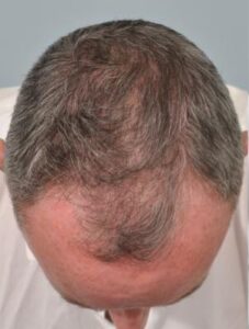 যেভাবে চুল বড় প্রতিরোধকরা যায়